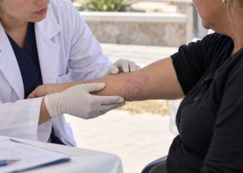 Se realizarán controles gratuitos para la detección de psoriasis