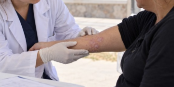 Se realizarán controles gratuitos para la detección de psoriasis